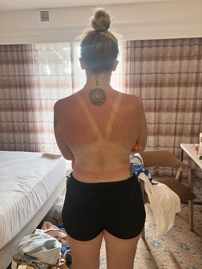 woman has bad sun damage